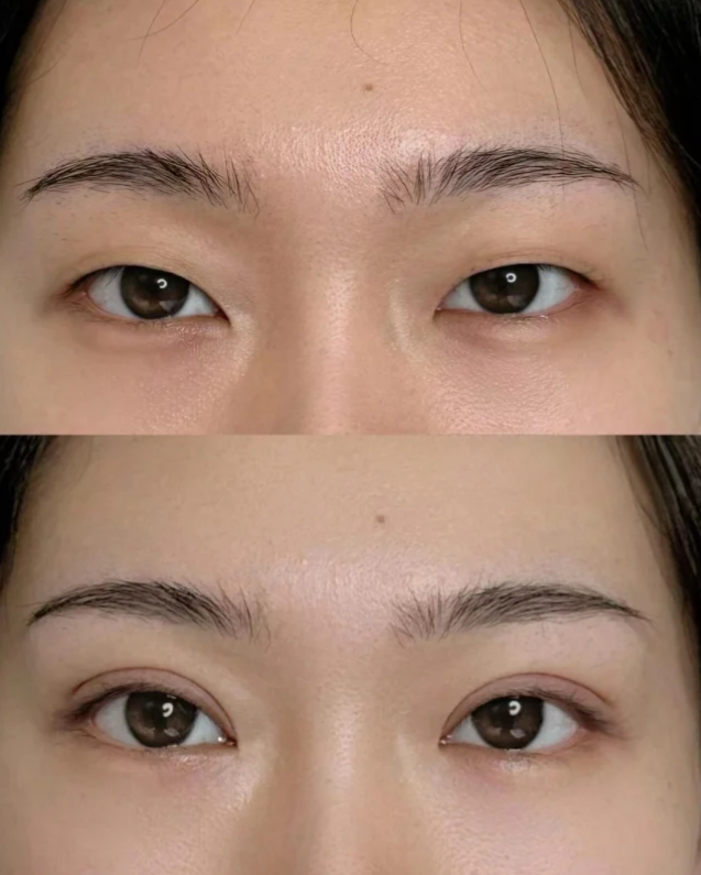 三、注射瘦脸怎么样？需要注意哪些关键事项