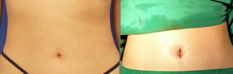 三、脸上好多疤痕怎么办的实用护理与注意事项