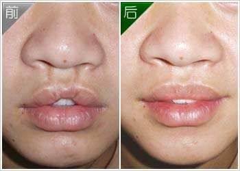 七、肉条修复的常见误区