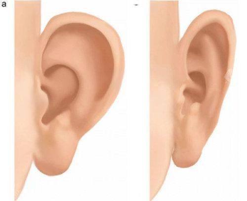 二、全切双眼皮形成肉条的常见原因