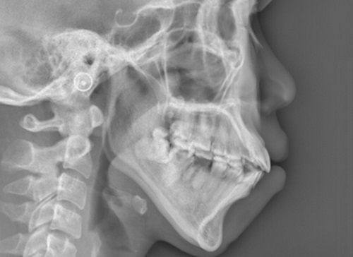 五、全切双眼皮有肉条能修复吗