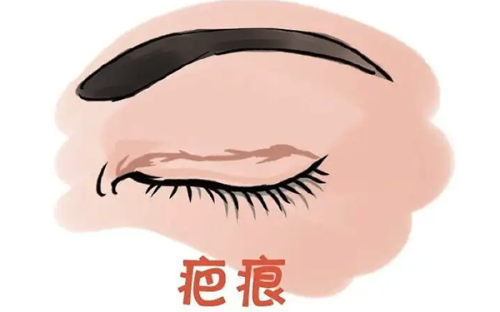 五、眼袋好多细纹怎么办