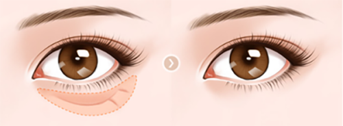 四、吸脂膨胀液几天流干净