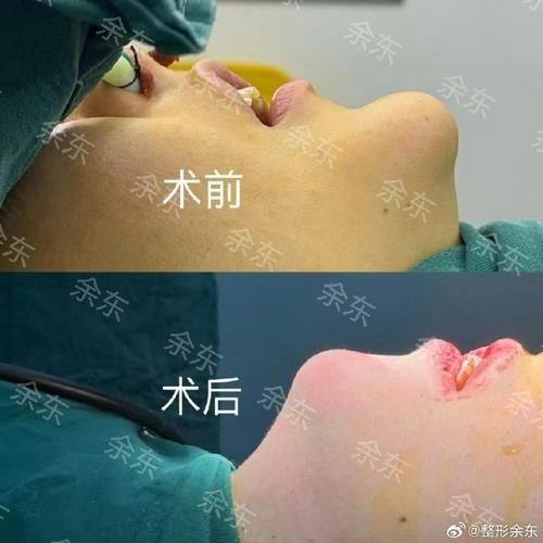 韩国V整形医院价格表：