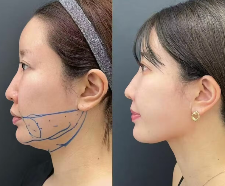 四、眼袋细纹怎么解决