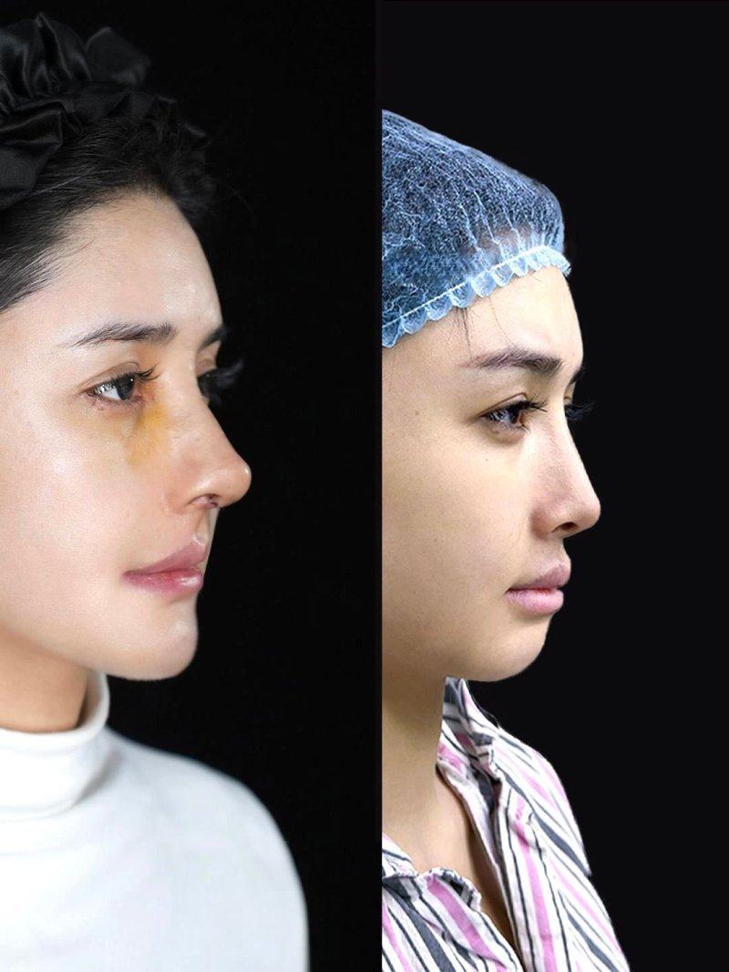 二、吸脂后膨胀液怎么排出