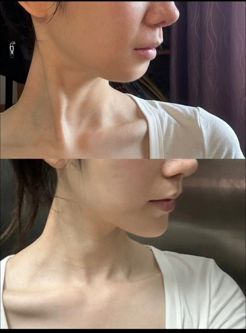 五、双眼皮整形的靠谱攻略指南