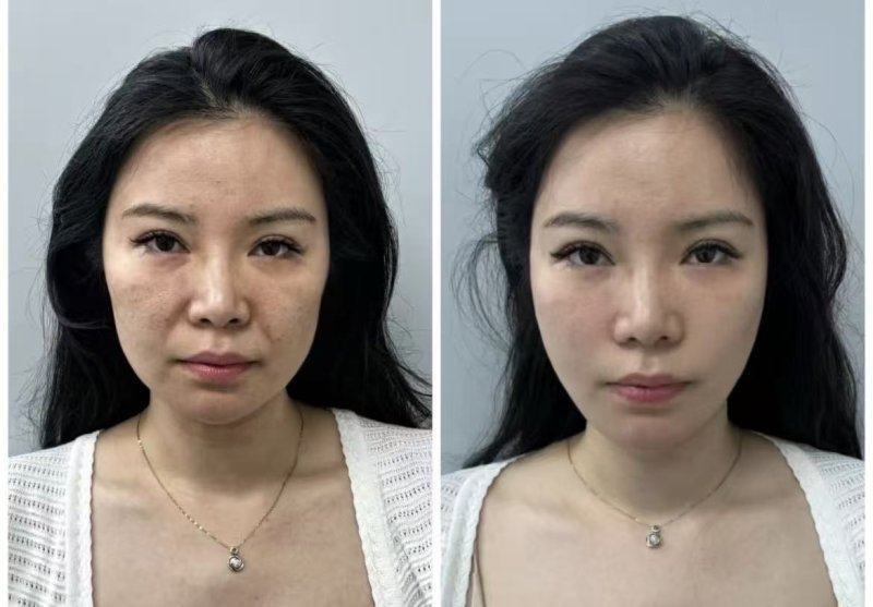 三、吸脂后膨胀液排不干净会怎样