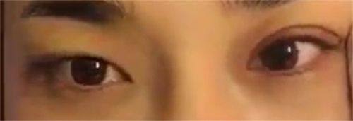 四、衡力瘦脸针凹陷实例的常见表现与认知误区