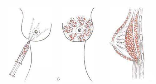 七、总结：现在做隆鼻怎么做的核心逻辑