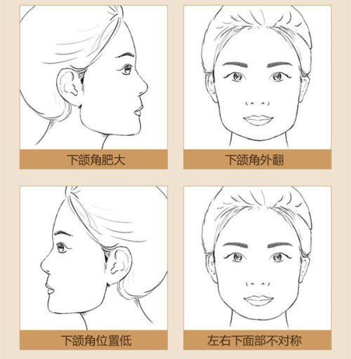 三、手术隆鼻（半肋鼻综合，2025年主流术式）完整流程