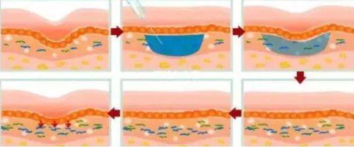 五、双眼皮埋线抽线相关常见疑问解答