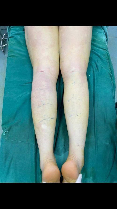 长沙如美整形医院价格表：