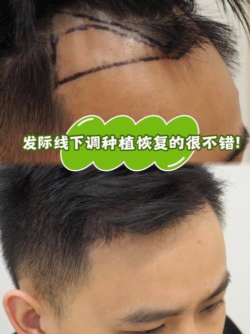 杭州碧莲盛植发医院地址电话及营业时间