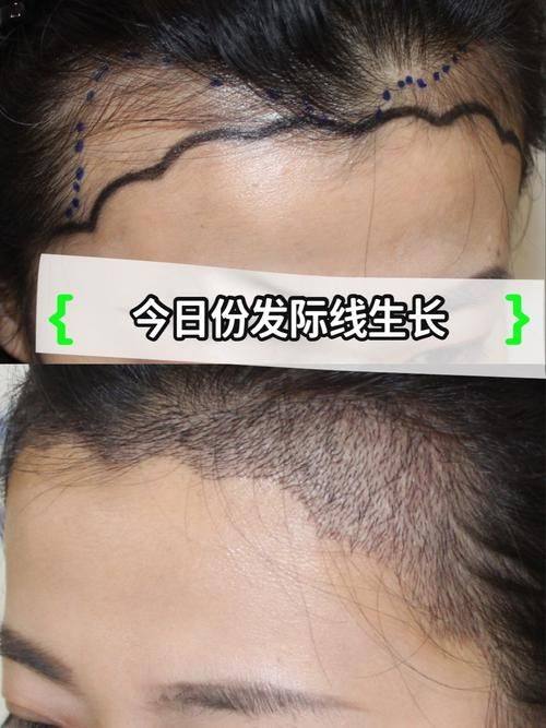 杭州碧莲盛植发医院口碑评价