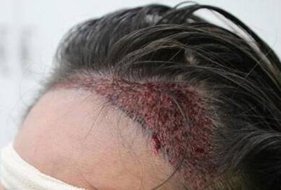 杭州碧莲盛植发医院擅长项目