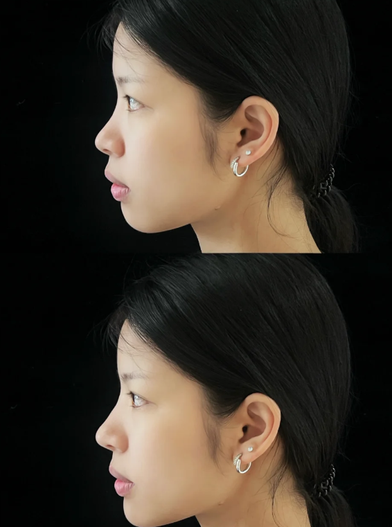 二、微创注射隆鼻完整流程