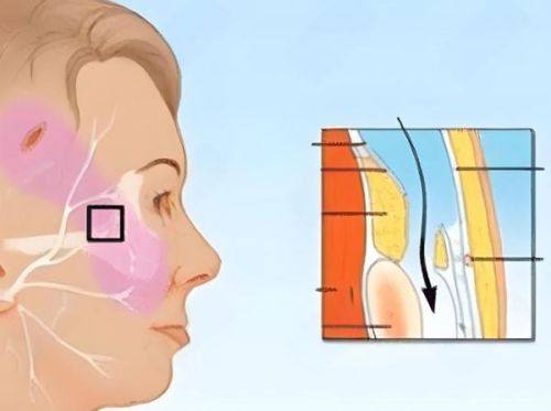 五、如何选择至佳的瘦脸针注射时机