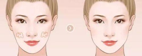 五、双眼皮疤痕增生更有效治疗方法