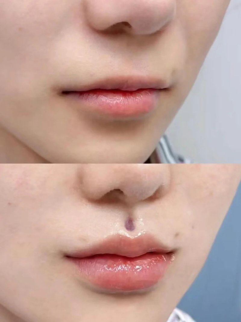 四、瘦脸针术后的核心护理要点