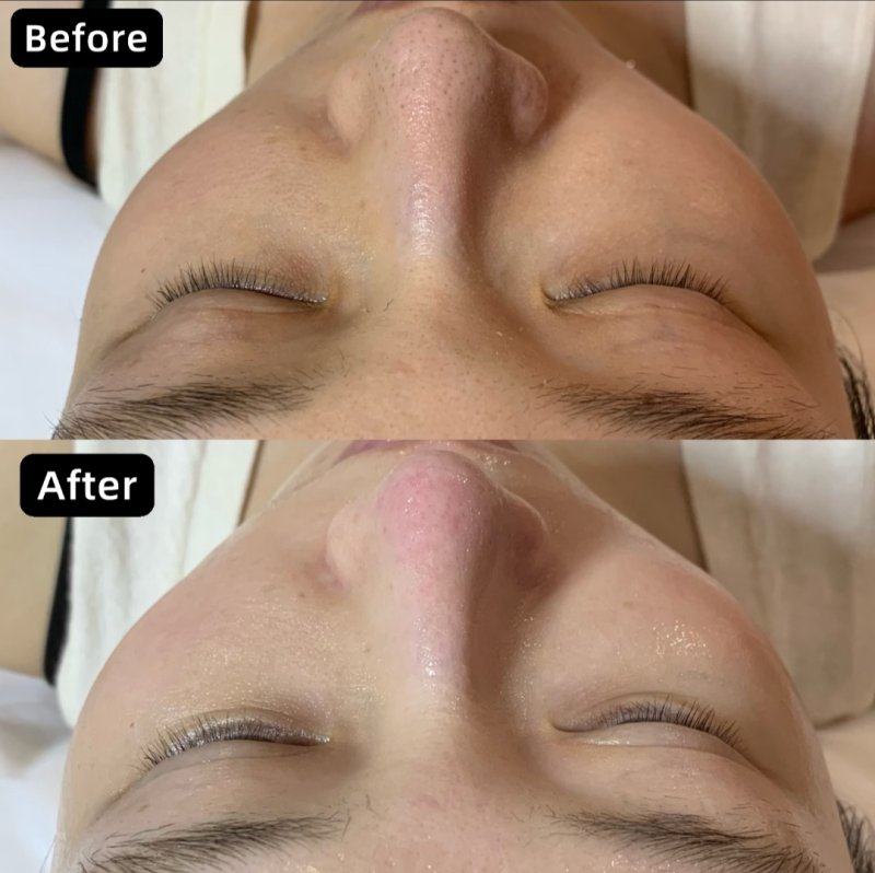 二、例假期打瘦脸针的多重影响